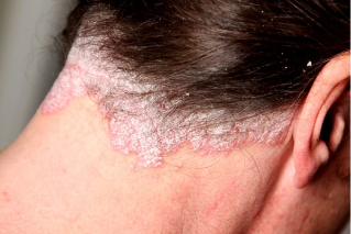 nappy psoriasia scalp